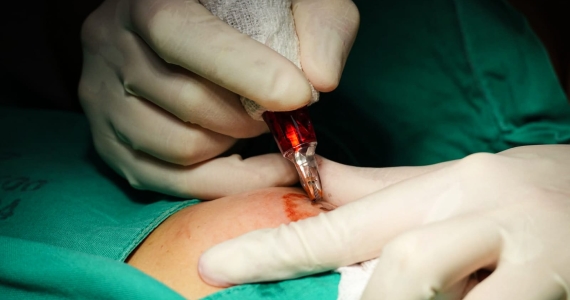 San Juan de Dios incorpora micropigmentación a la reconstrucción mamaria