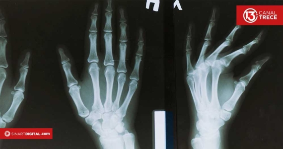 Mala alimentación que puede debilitar sus huesos y causar osteoporosis antes de los 50 años