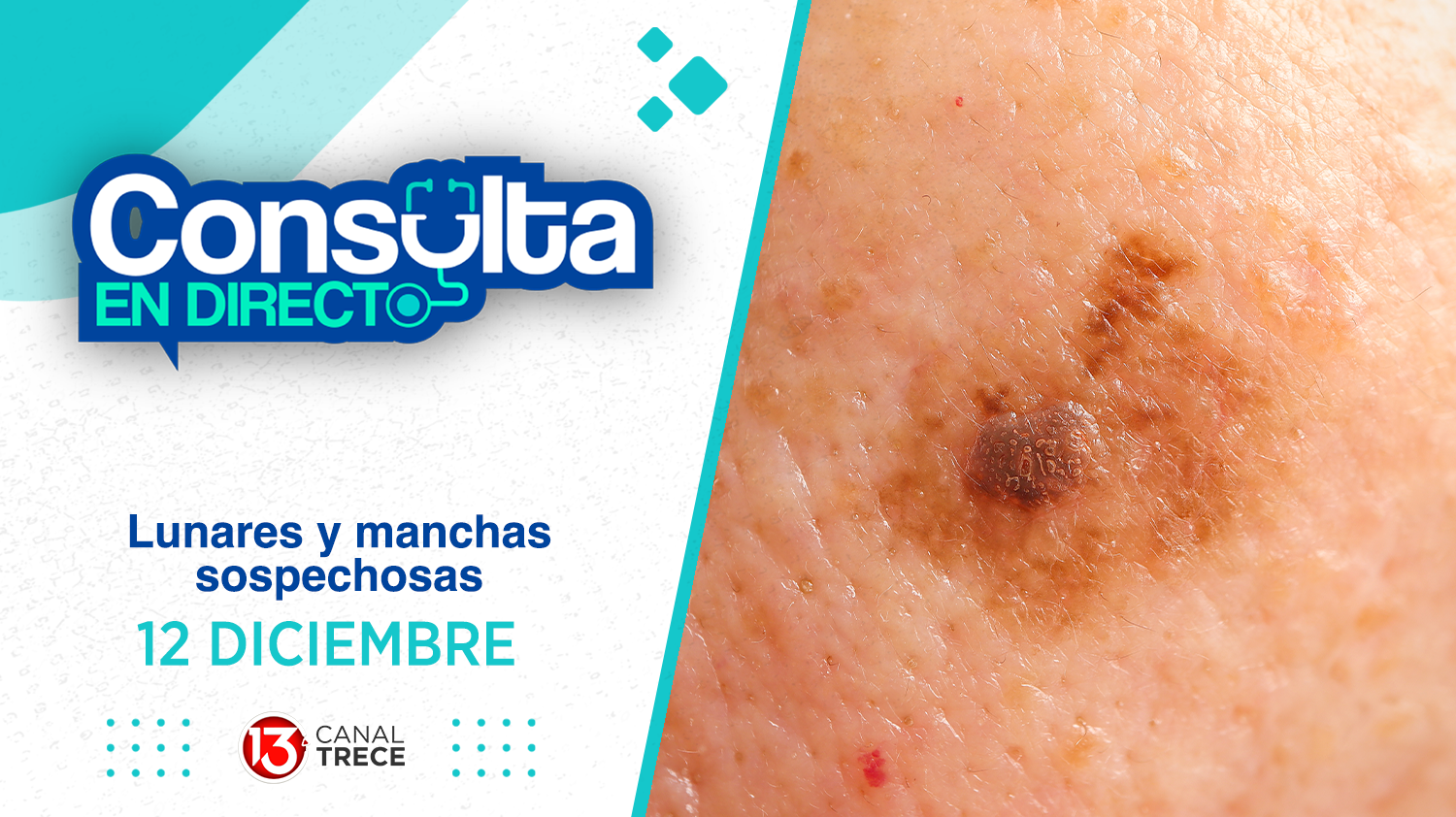 Lunares y Manchas Sospechosas | Consulta en Directo 12 Diciembre 2024. Programa completo 