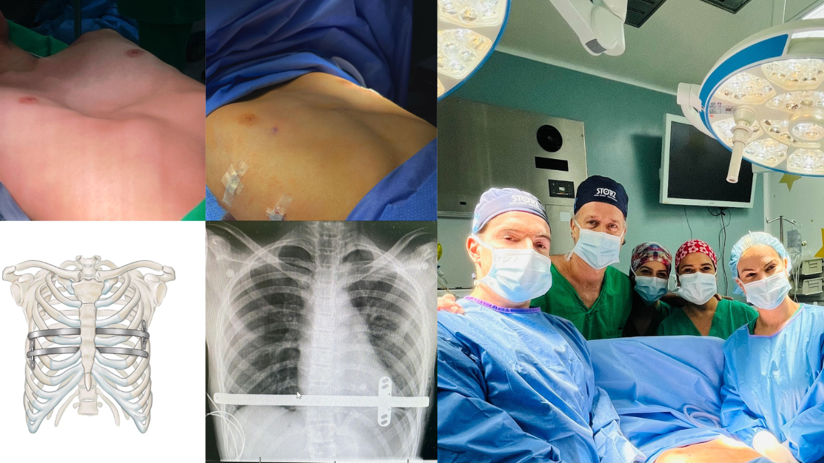 Hospital de Niños realizó con éxito 8 cirugías torácicas 