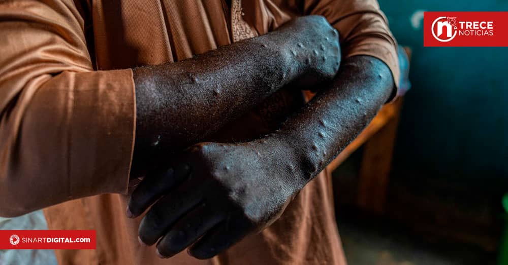 Un primer caso de la nueva variante de mpox identificado en Francia