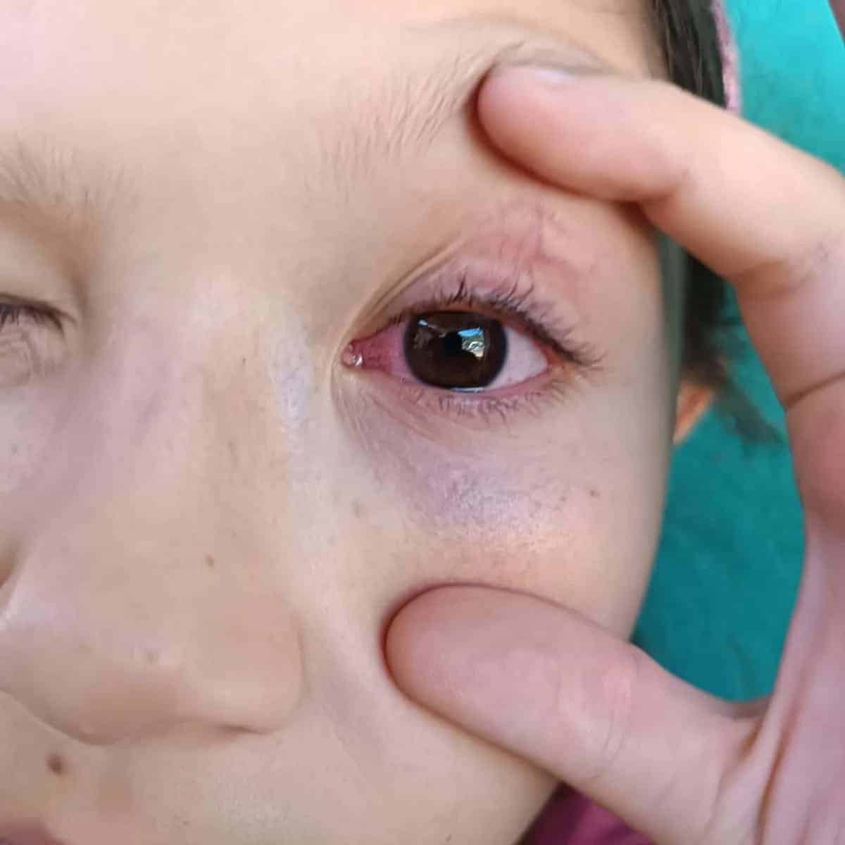 Niña fue golpeada por compañero en centro educativo y ve afectada su visión