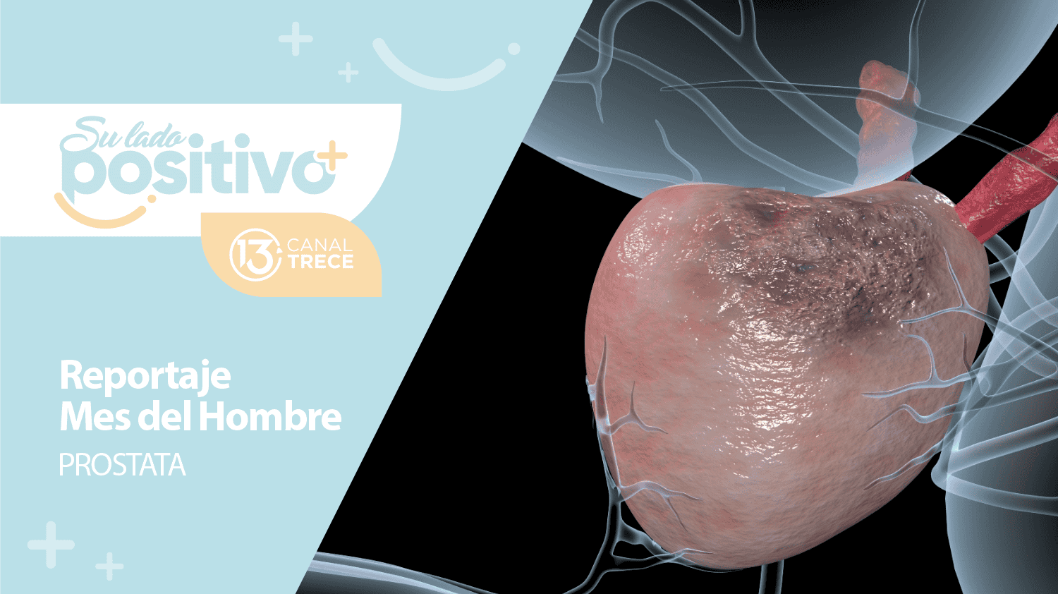 Cáncer de Próstata: Una realidad para 1 de cada 6 hombres