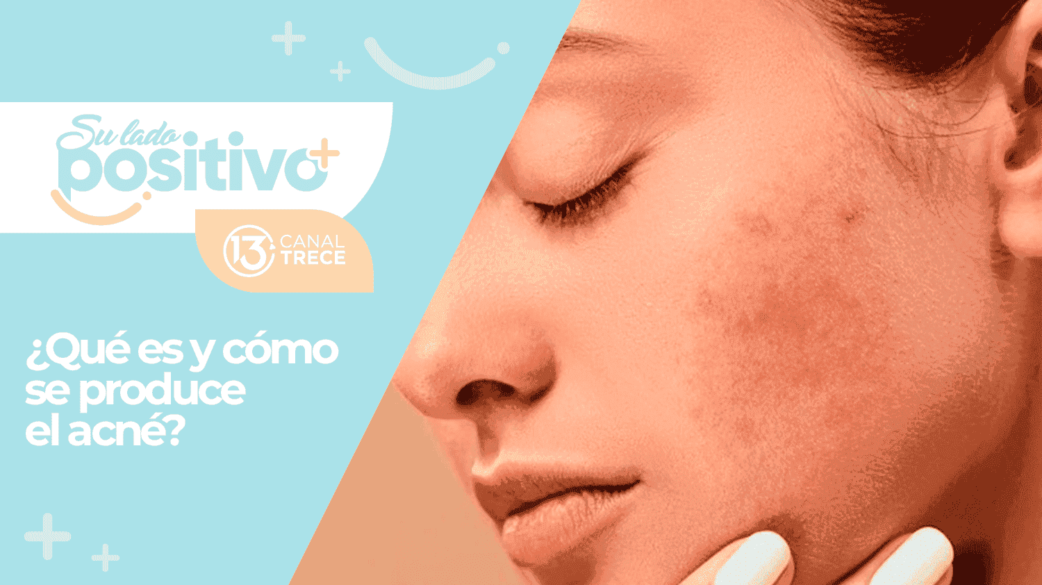 ¿Qué es y cómo se produce el acné?