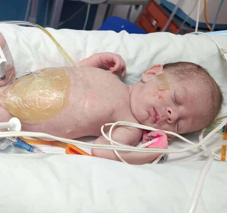 Cirugía Exitosa: Keyleth fue operado aún estando conectado a su madre