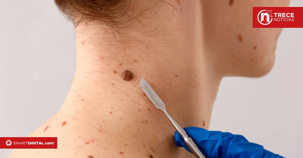 En Costa Rica se diagnostican siete casos de cáncer de piel por día