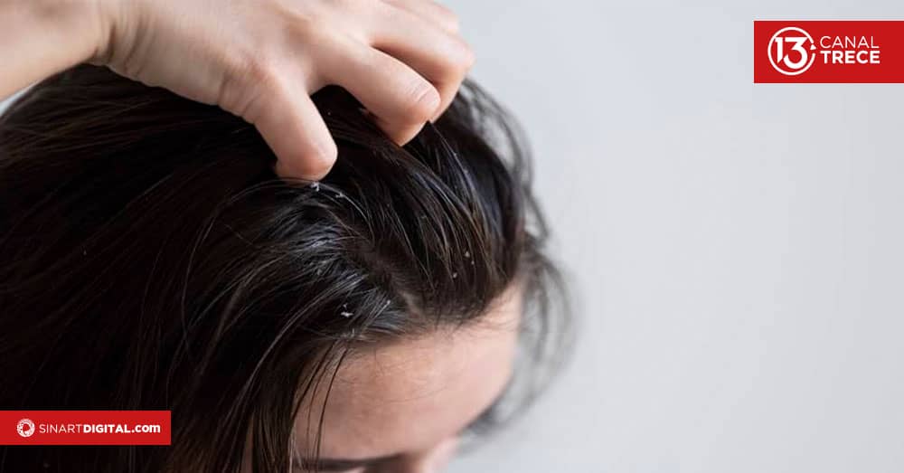 Medicina natural para eliminar la caspa. 