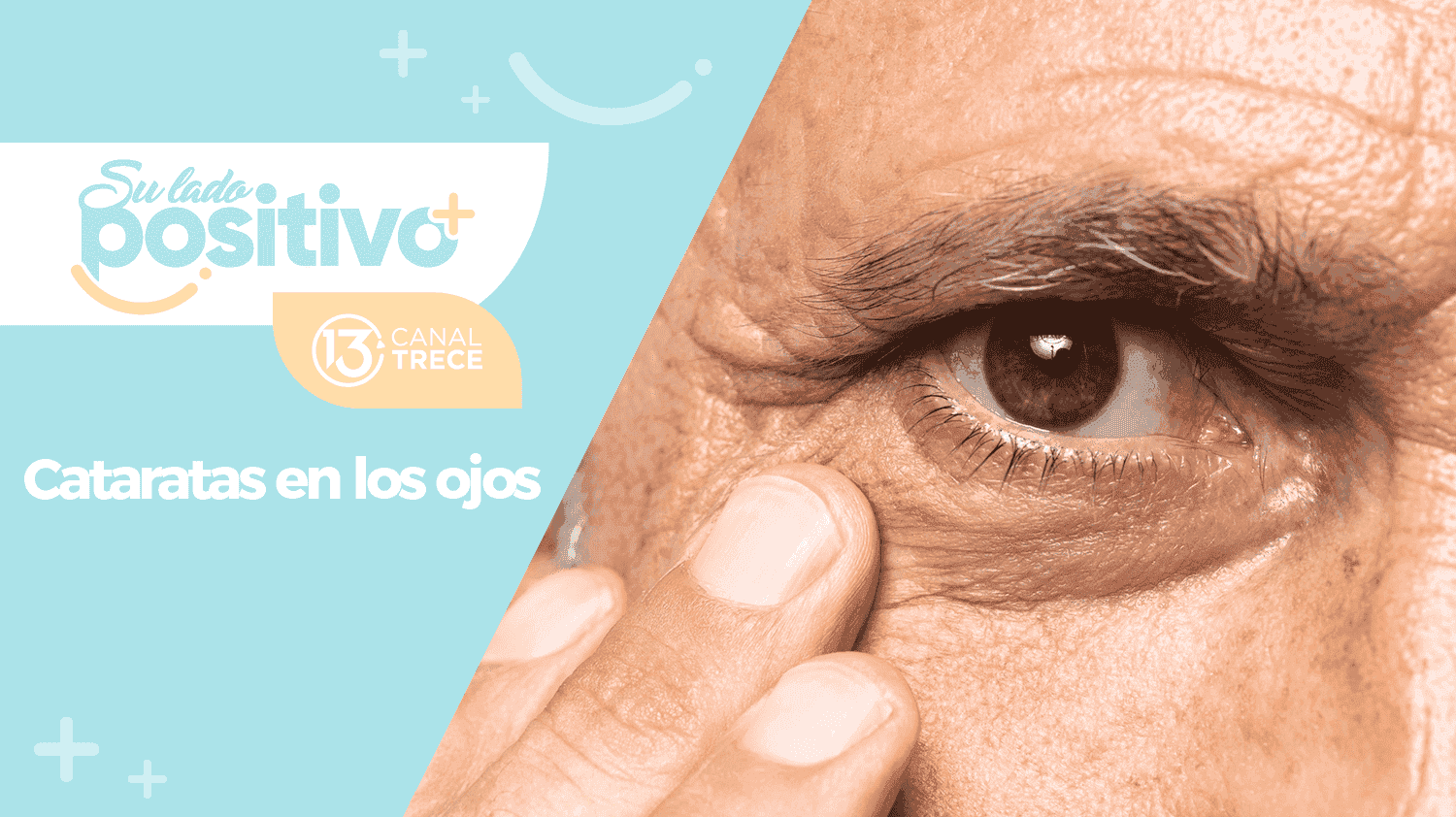 Cataratas en los ojos