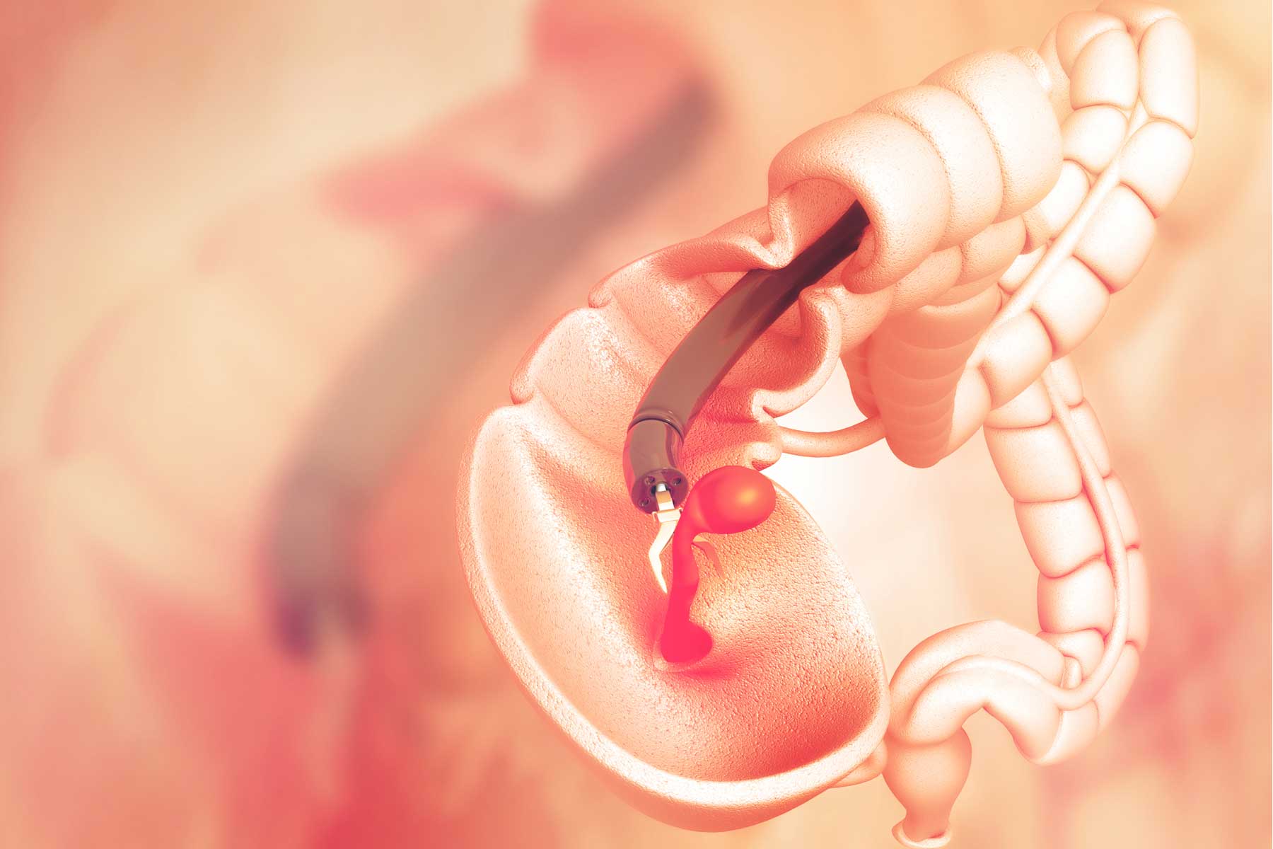 Colonoscopías: Un paso crucial hacia la prevención del cáncer de colon que muchos omiten