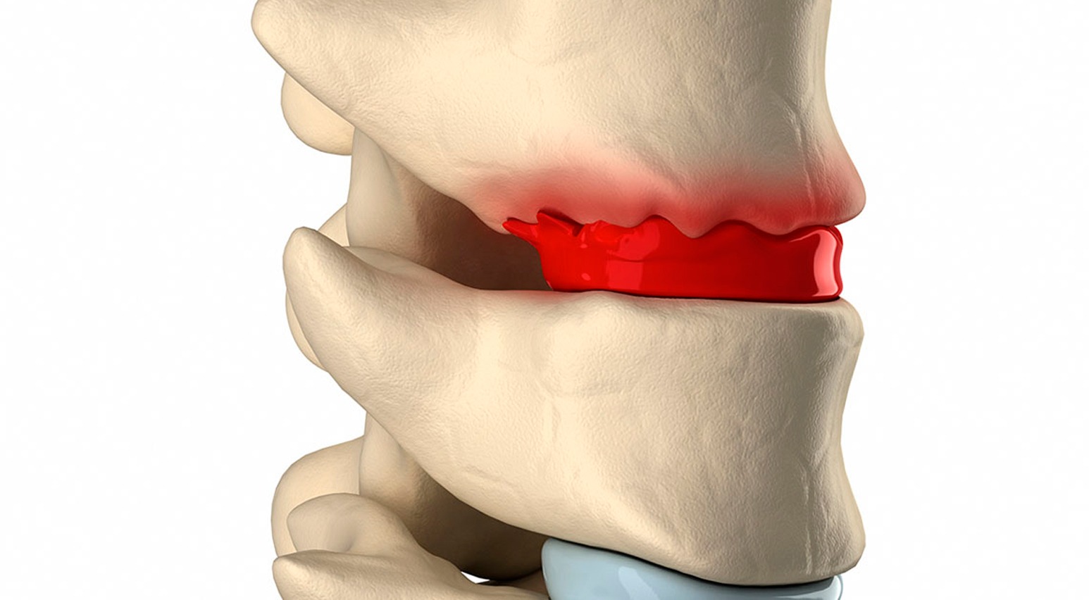 CCSS atiende 15 mil casos anuales de problemas de columna vertebral