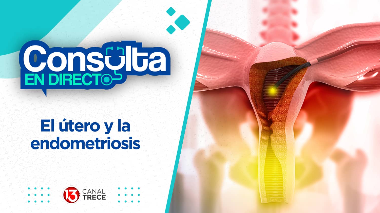 El útero y la endometriosis | Consulta en directo 13 junio 2024. Programa Completo.
