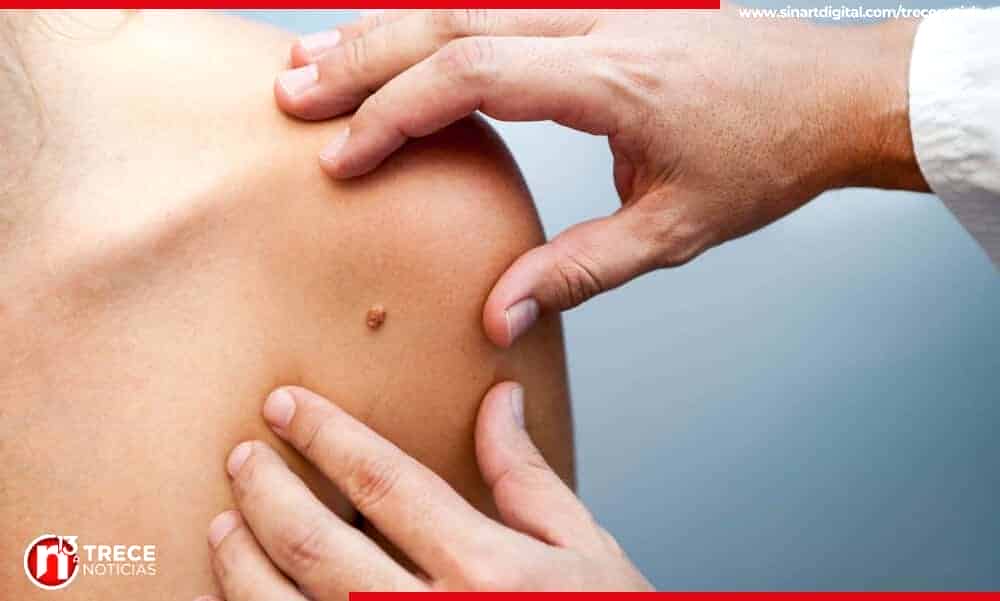 Jornada de detección de cáncer de piel llega hoy al Parque Nacional de San José