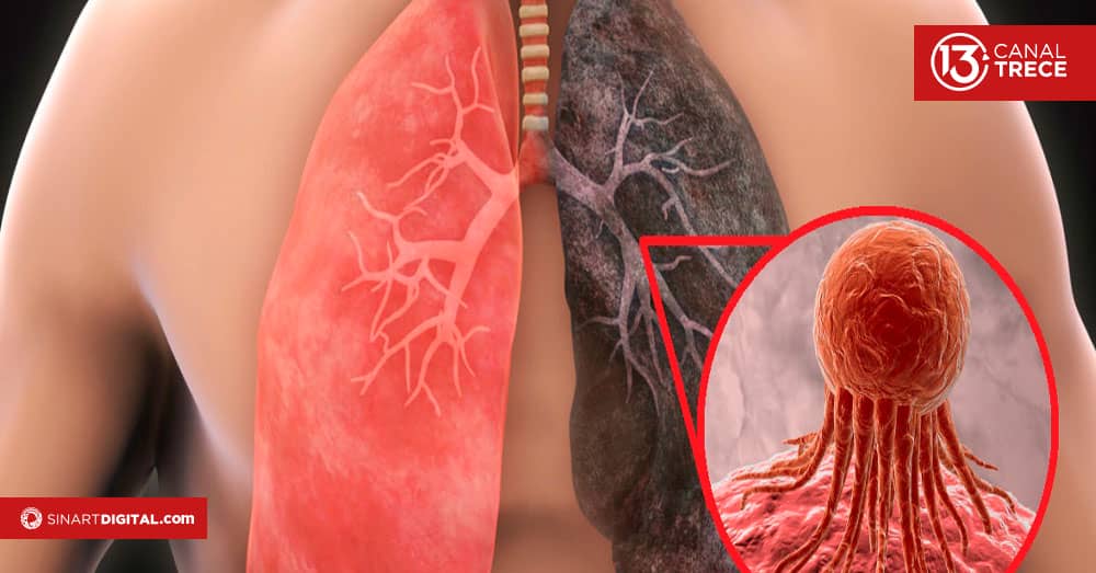 ¿Cómo combatir el cáncer de pulmón?