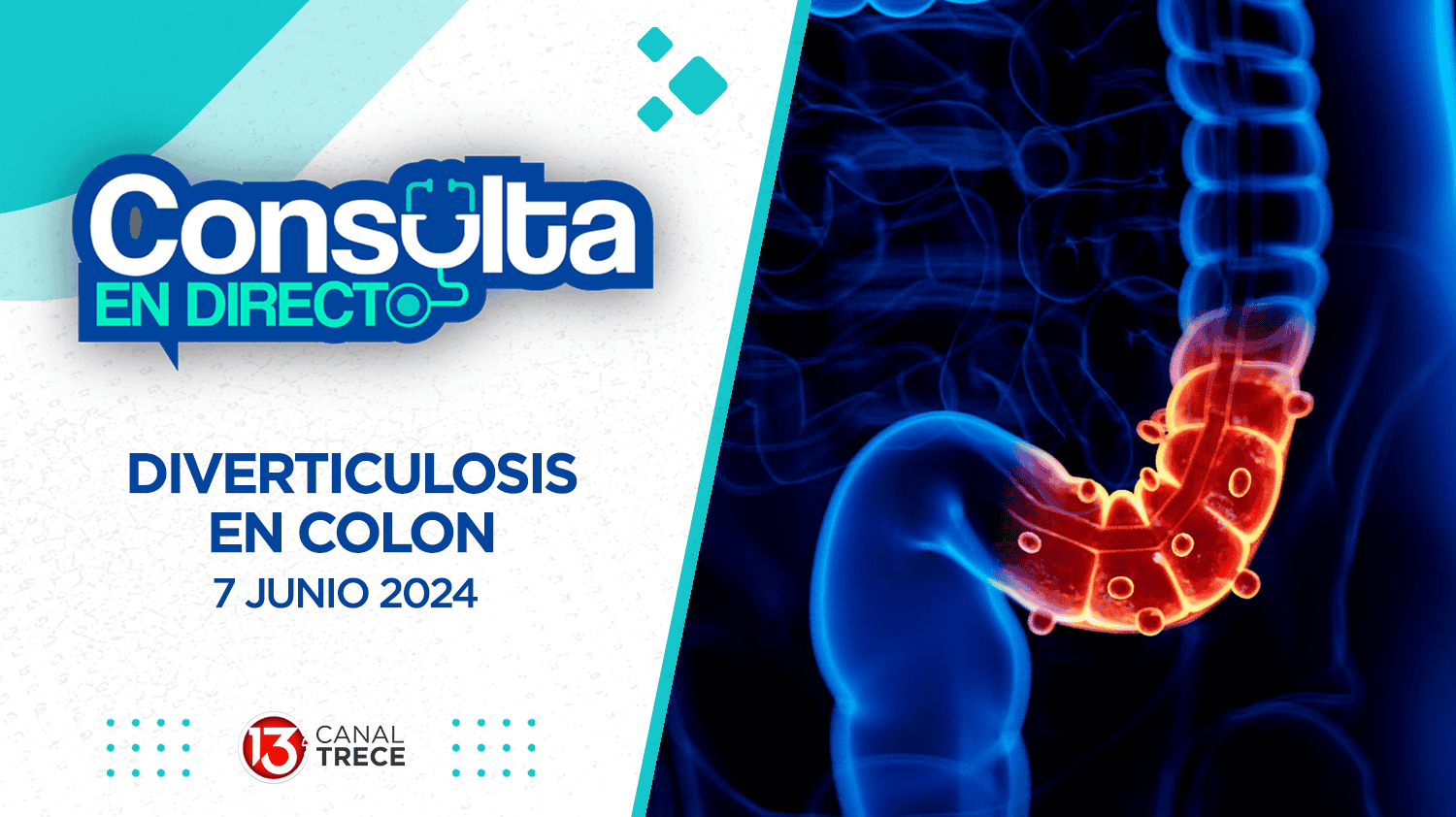 Diverticulosis en colon | Consulta en directo - 7 Junio 2024. Programa Completo