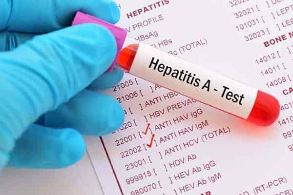Ministerio de Salud reportó brote de hepatitis A 