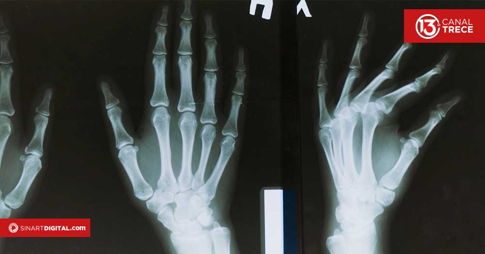 Mala alimentación que puede debilitar sus huesos y causar osteoporosis antes de los 50 años