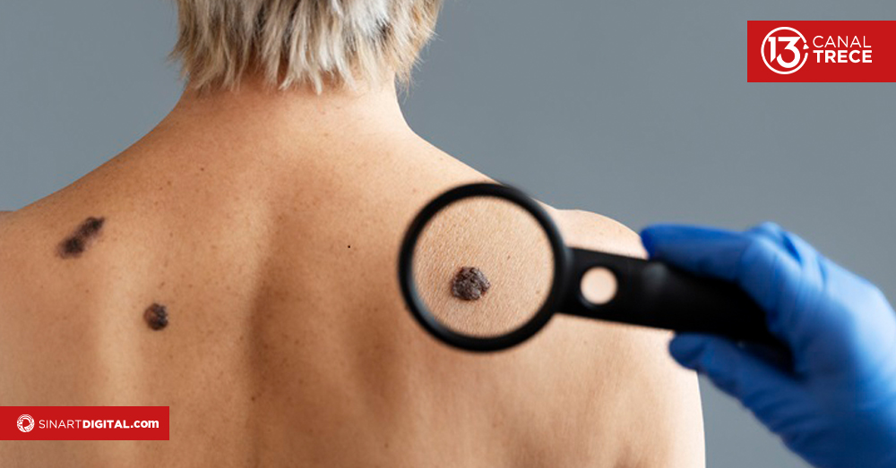 Cáncer de piel: prevención y tratamientos.  