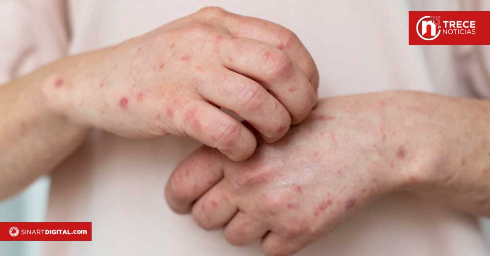 CCSS amplía vacunación contra sarampión para viajeros desde los 6 meses de edad