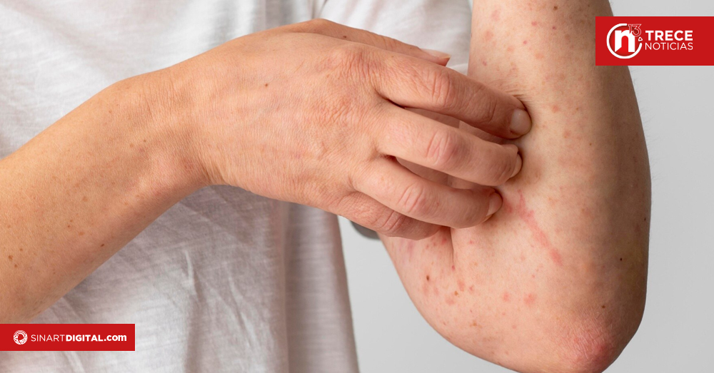 Salud Actualiza Protocolo de Vigilancia por Aumento de Casos de Sarampión y Rubéola en la región