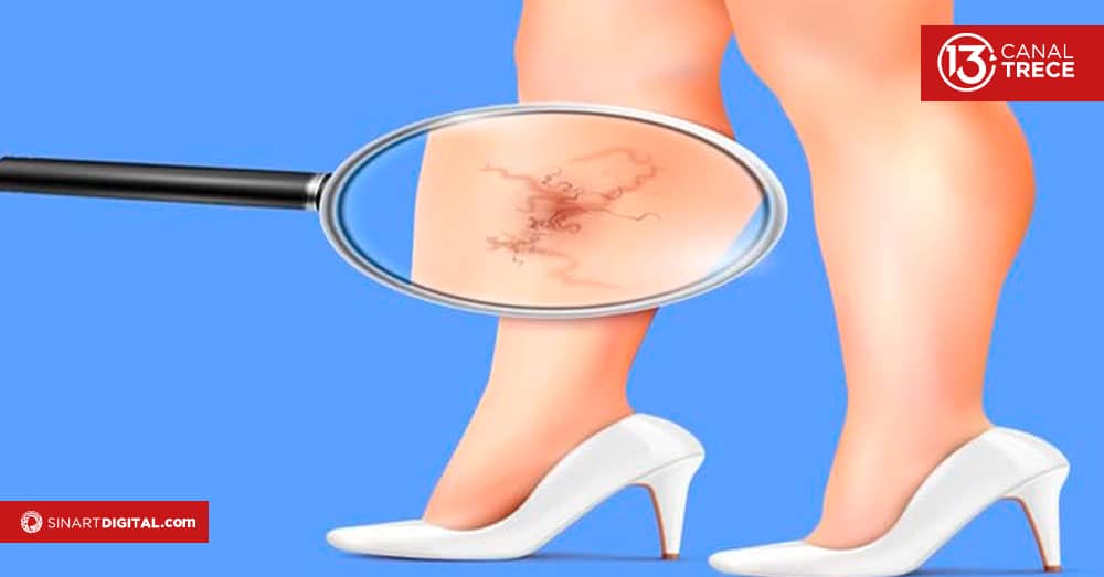 ¿Cómo tratar los vasos capilares?  