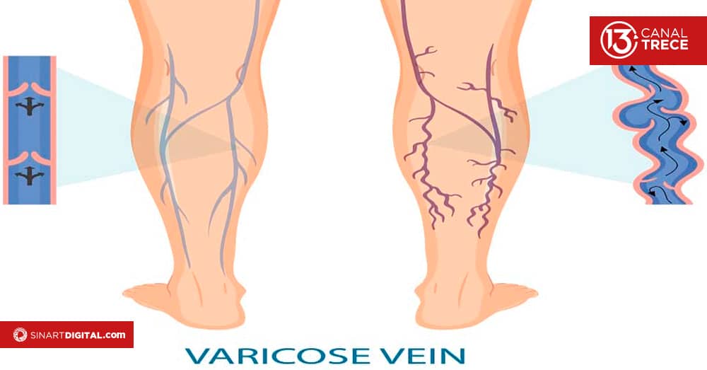Las varices se pueden evitar con el ejercicio físico y la alimentación saludable. 
