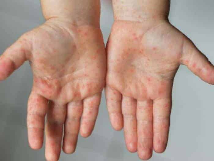 Viruela del mono dejó de ser emergencia sanitaria global: OMS